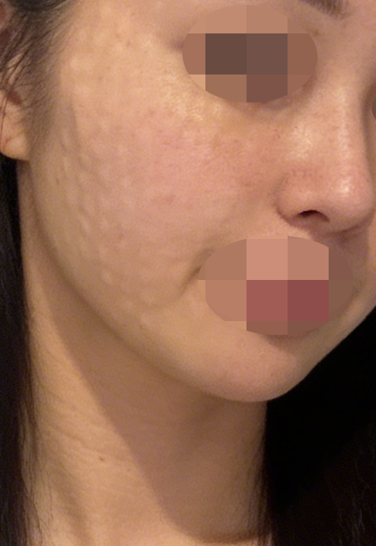 수면 리쥬란 받았는데 너무 만족이에요 ㅎㅎ