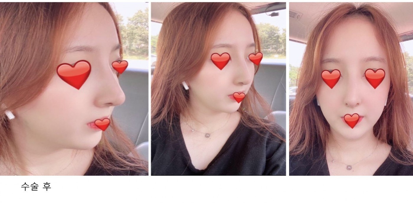 복코 휜코 매부리코 수술했어요~~!