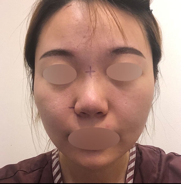 복코성형후기+_+