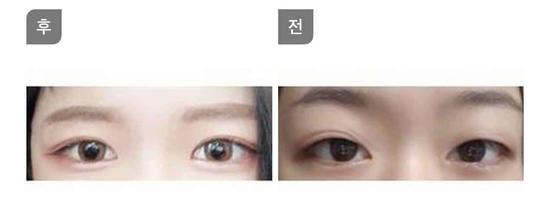 쌍꺼풀+눈매 교정 후기에용