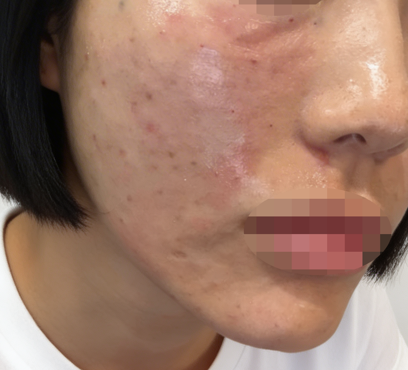 예민한 피부인데 리쥬란 받고 진정되는 느낌이에요~ 일부러 강남역에서 가까운 곳 오길 잘한 것 같아요!
