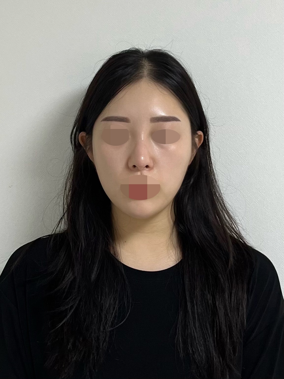 아직은 붓기가 덜빠진거라는데 다빠지고나면 얼마나 더 맘에들런지 ᄒᄒᄒᄒ코