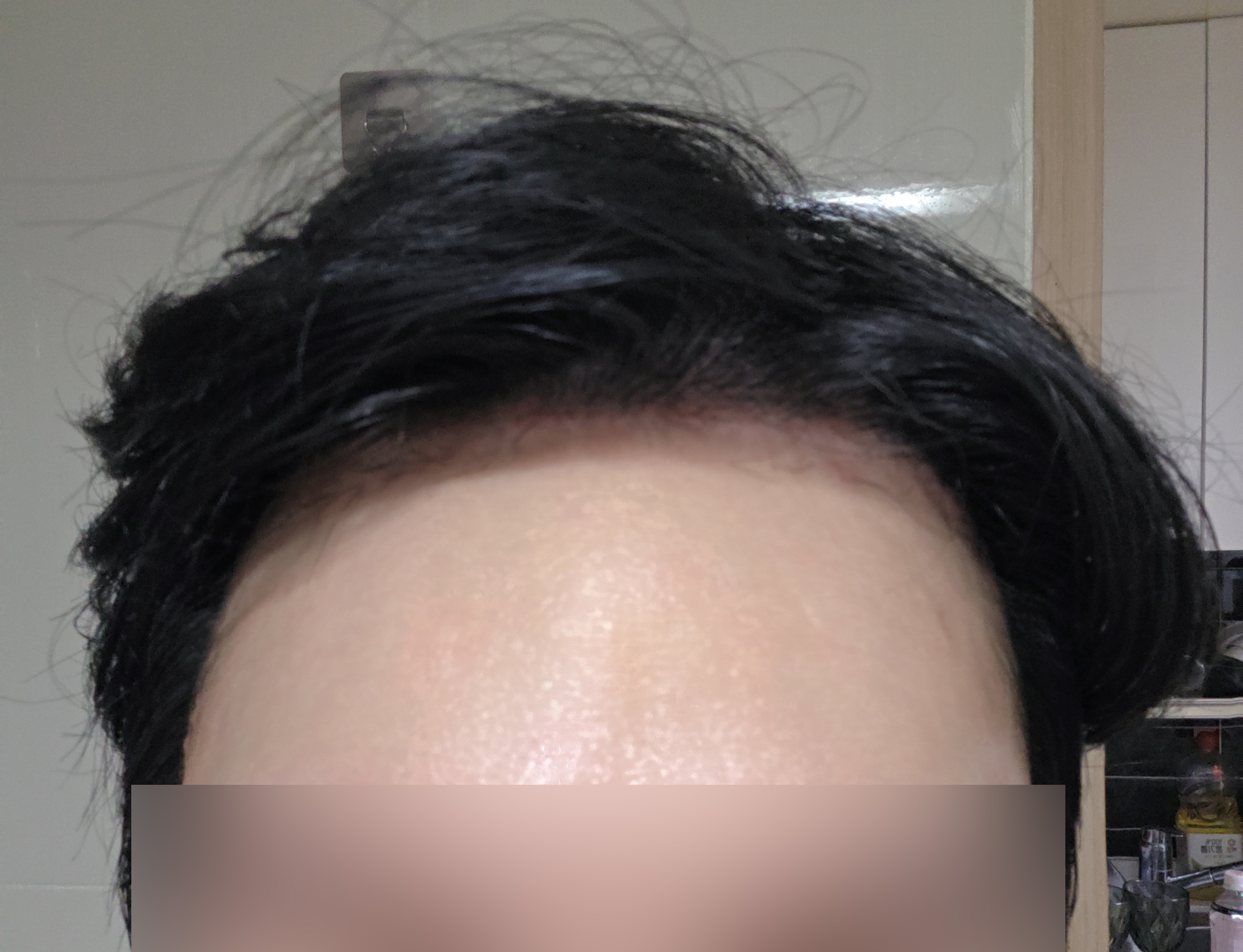 헤어라인이 자연스럽게 자리 잡고 있는 비절개 무삭발 1달차 후기