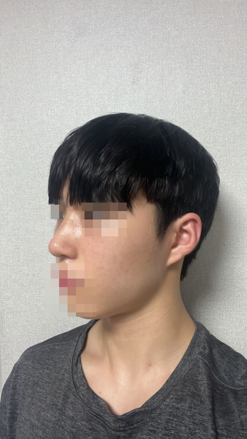 수술 후 최웅규 원장님께서 잘 봐주셔서 부작용 없이 잘 지내고 있습니다!