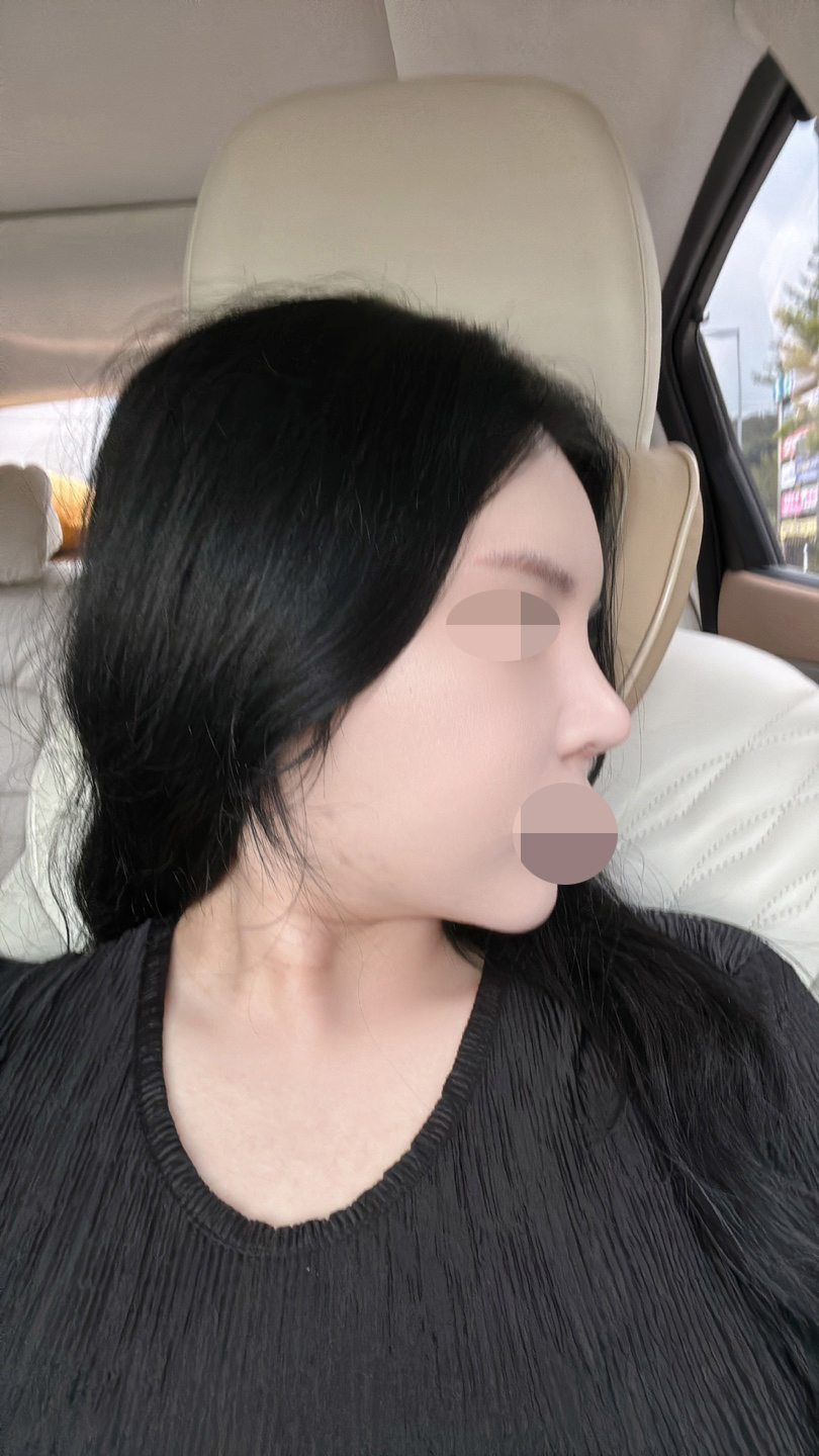 코끝이 올라가고 콧구멍이 덜 보여서 만족해요