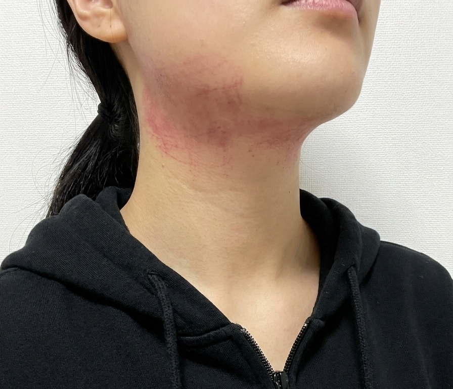 두둑한 얼굴 고민으로  방문했는데 친절한 응대에 꼼꼼한 케어까지, 인모드 받길 잘했어요! 