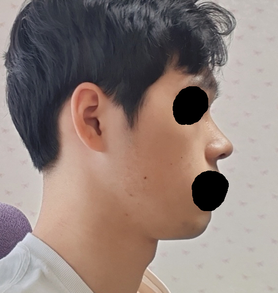 수술한지 2주가 지나가는데 코에 약간의 통증만 있고 수술하기 전처럼 생활하고 있습니다.