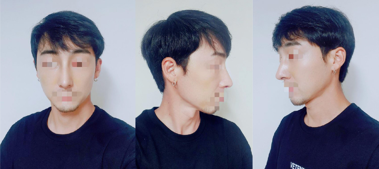 남자 코수술 후기입니다