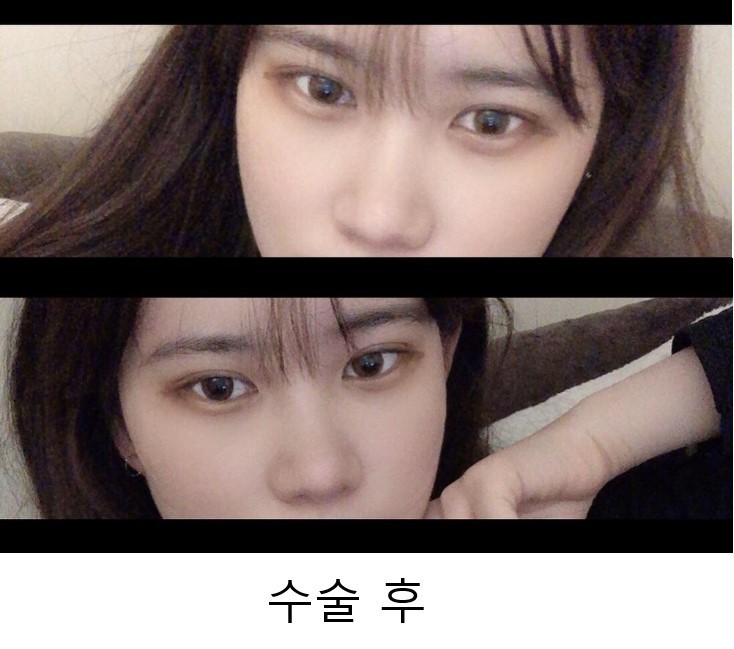 복코 + 눈재수술 후기입니당_!