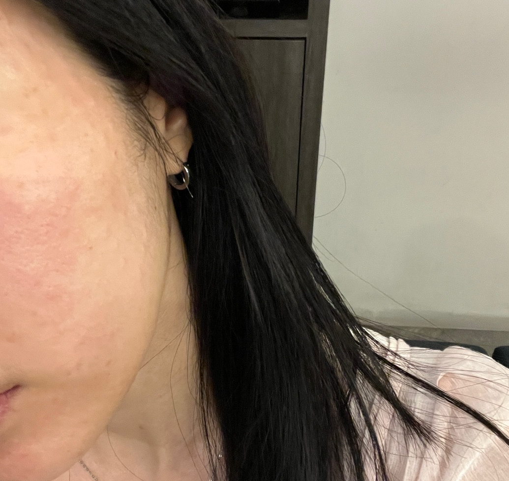 평소 궁금했던 리쥬란, 수분 부족해서 드디어 받아봤어요~ㅎㅎ