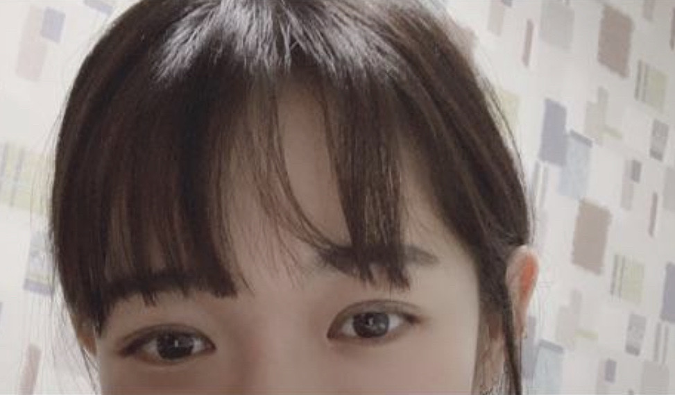 눈매 교정,쌍커풀 수술했쯤당