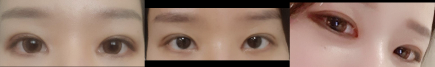 눈매교정 + 매몰 + 앞트임