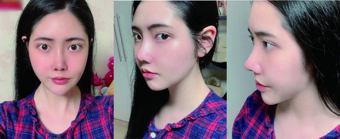 코성형 한지 일주일차 후기입니당
