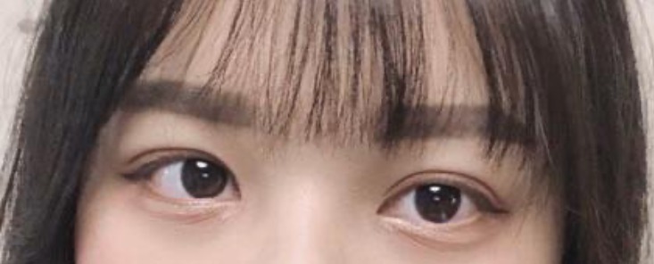자연유착 + 앞트임