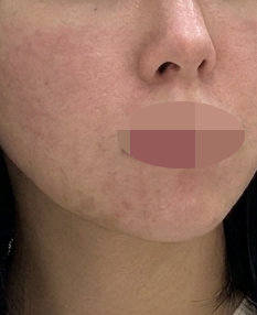 모공이랑 화장 들뜸 고민, 포텐자로 잡으러 다녀왔어요!
