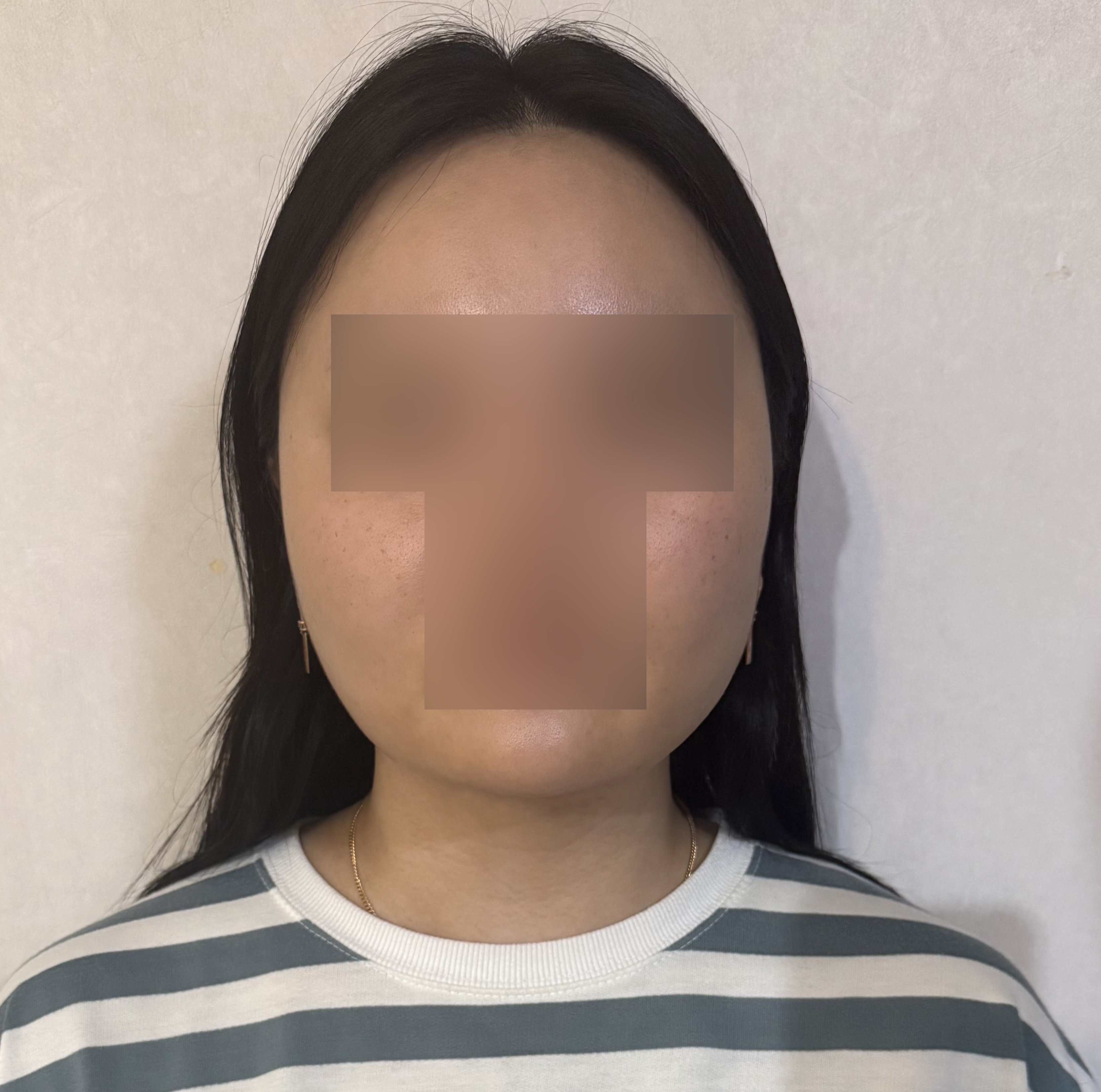 이중턱·턱라인 지방흡입 1개월 차 후기 (일상 복귀 빠르고 통증 적음)