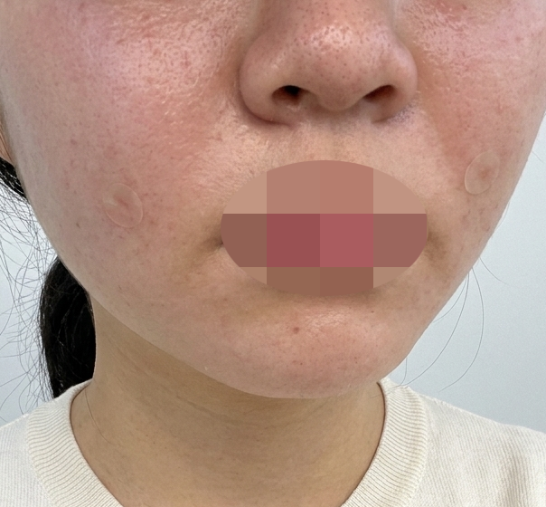 팔자주름 신경 쓰여서 방문, 레이어스 콜라겐부스터로 결정했어요!