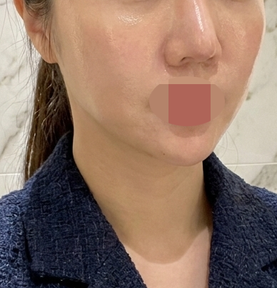 홍조에 모공, 각질까지 고민 많았는데 시술하고 없어졌어요ㅎㅎ~