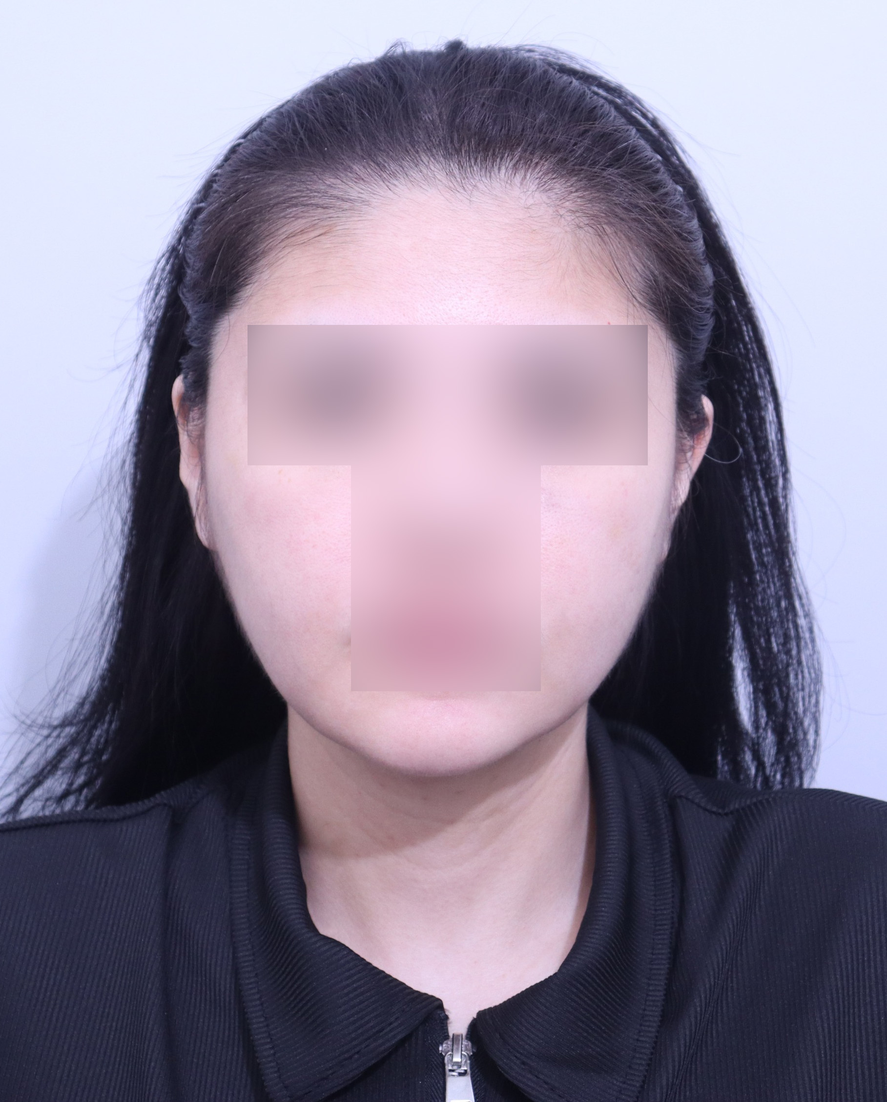 이중턱 턱라인 지방흡입 1달차, 턱선이 점점 살아나고 있어요