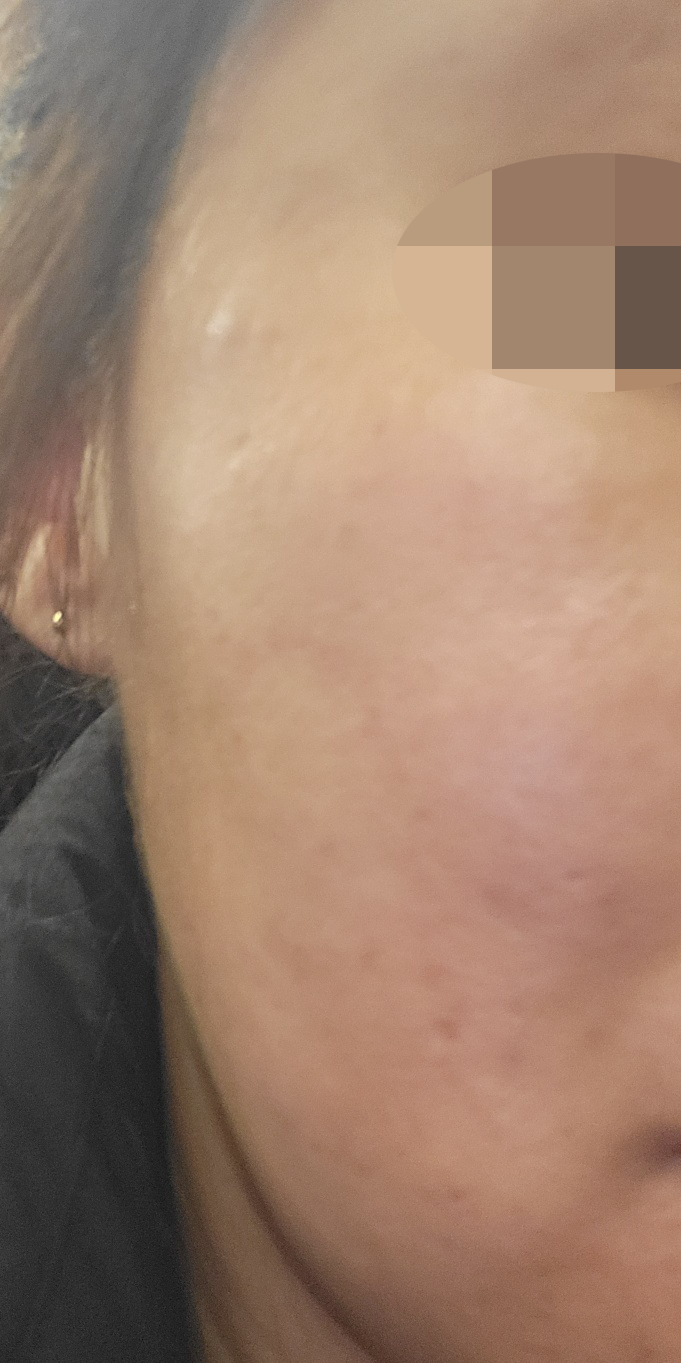모공 고민으로 받았는데 3개월치 추가 결제하고 왔어요 ㅎㅎ