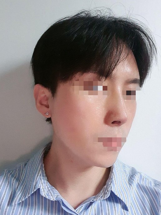 1주차 코끝수술 후기