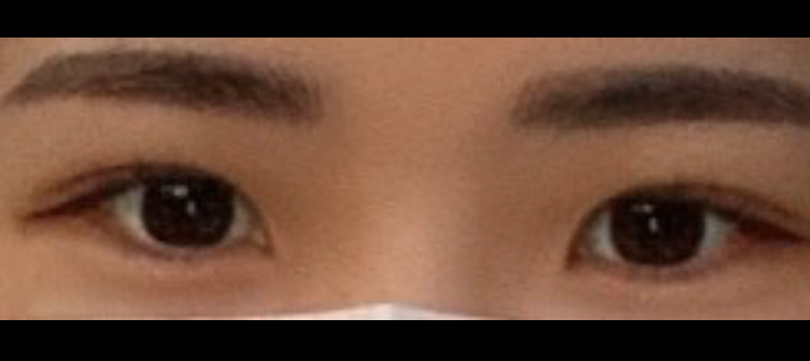 자연유착 수술 했어용