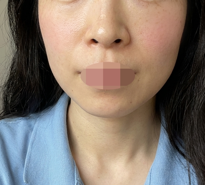 피부톤 개선이랑 잡티 잡으려고 토닝 받으러 방문했어요!