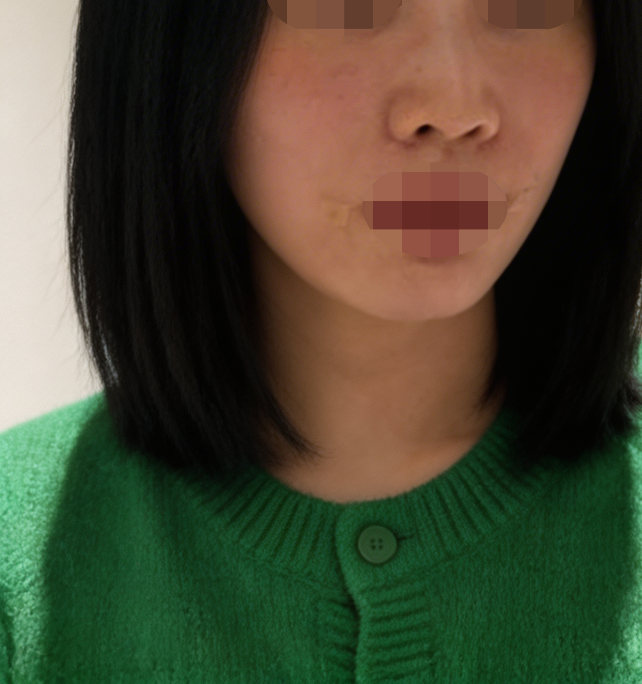 모공 고민으로 왔는데 수면으로 편하게 받고 대기도 짧았고, 일본 통역 덕분에 편했습니다~