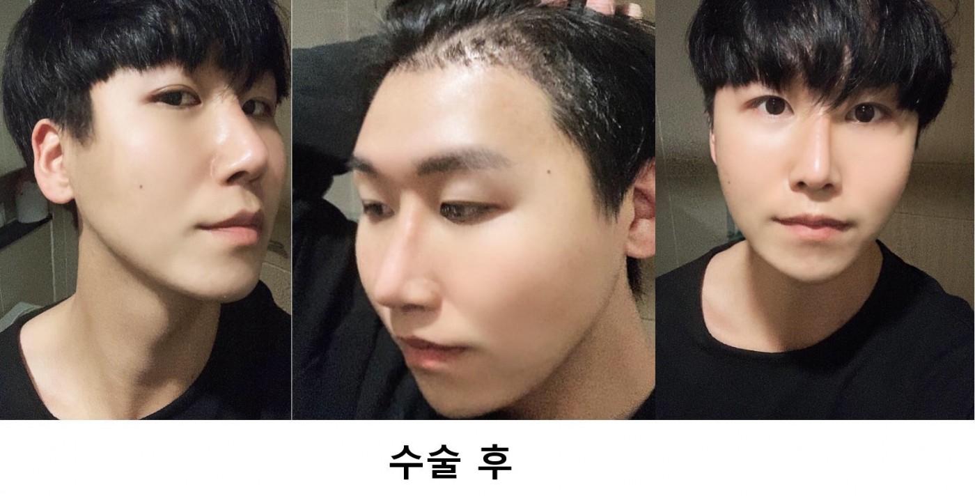 모발이식 1주차