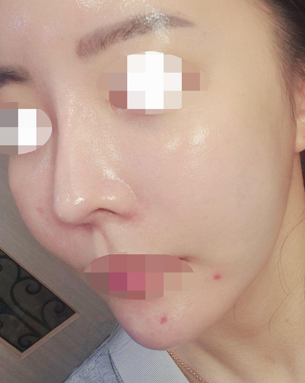 눈가 건조함이랑 피부결 고민으로 방문해서 시술로 한번에 해결했어요~ㅎㅎ