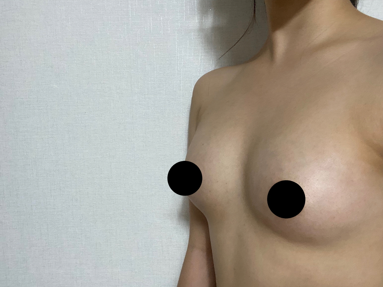 티 안나게 한컵정도 커지고싶은분들 완전 강추합니다
