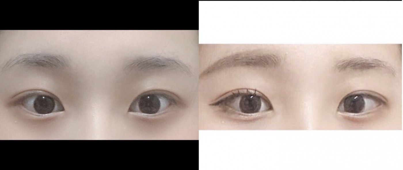 자연유착 후기