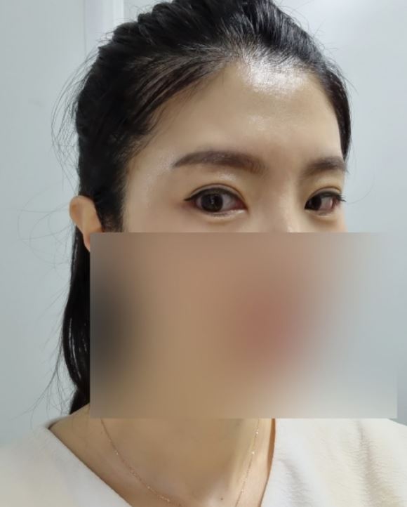 눈 재수술 후기