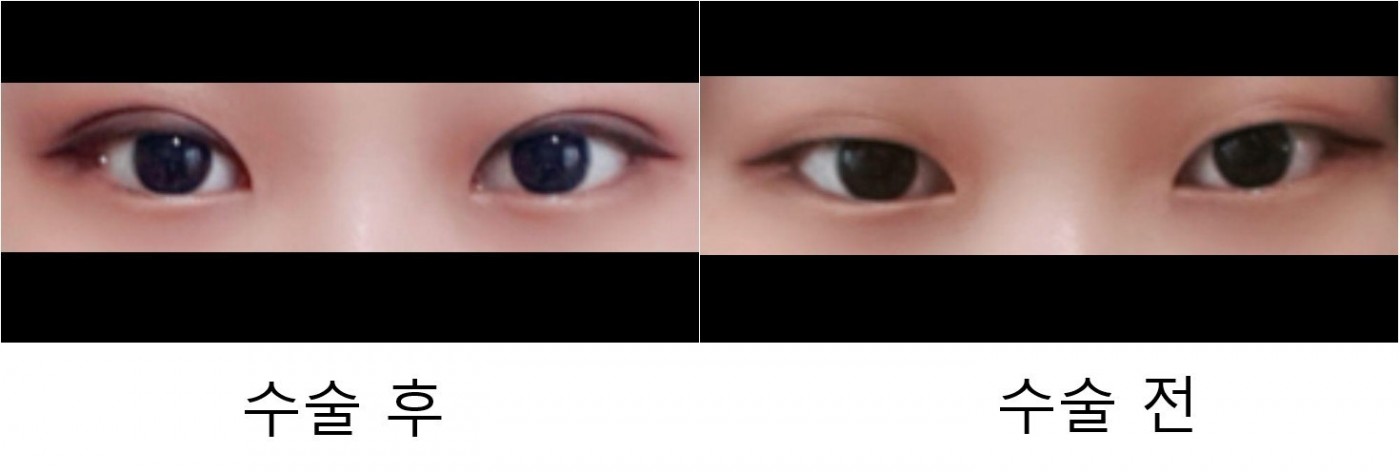 눈매교정 자연유착 수술후기