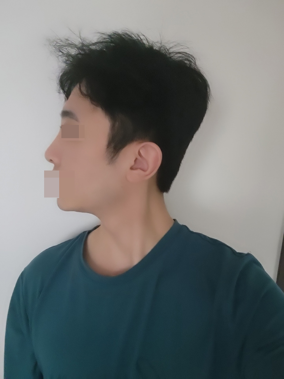 수술 4개월차 한듯안한듯 자연스럽게 잘되었어요