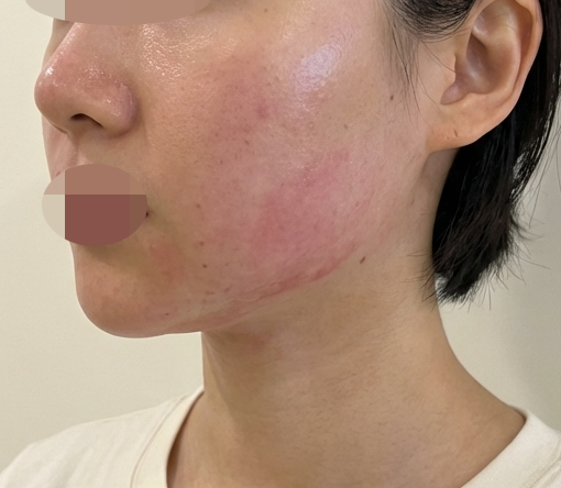 리프팅 고민으로 온다리프팅 수면으로 받으러 방문했어요!