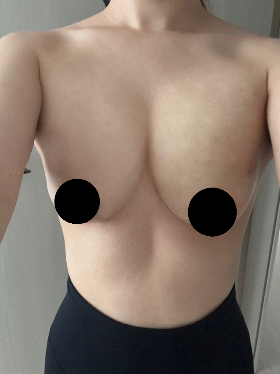 윗볼륨 고민으로 갔는데 예쁘게 채워졌어요 ㅎㅎ