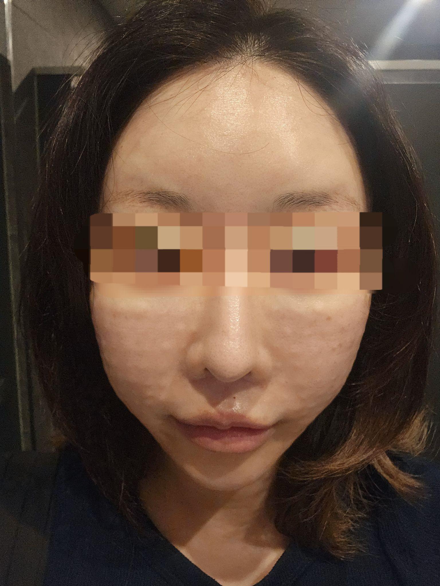 친절하고 신속한 리쥬란, 효과가 벌써 기대됩니다