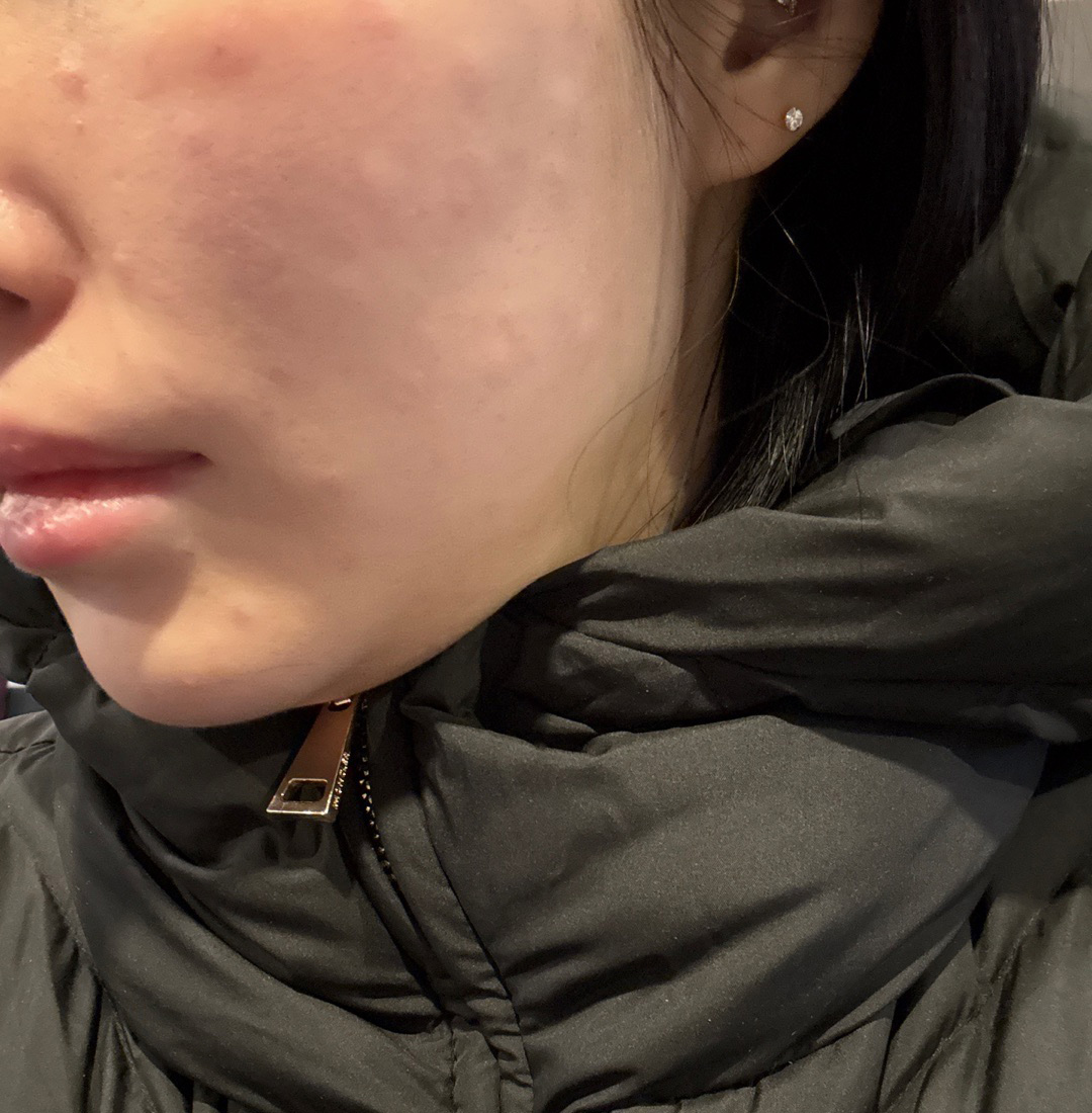 점심시간에 잠깐 받기 딱 좋아요~ 계속 받으니 효과도 좋아지는 중!