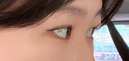 서울아이성형외과 황정일 원장님께 수술 받은지 한달째 입니다