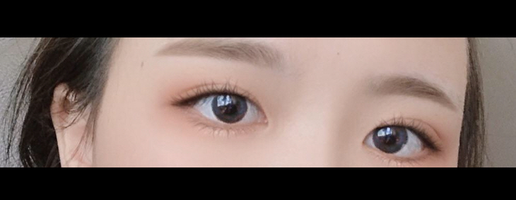 눈매교정 쌍꺼풀