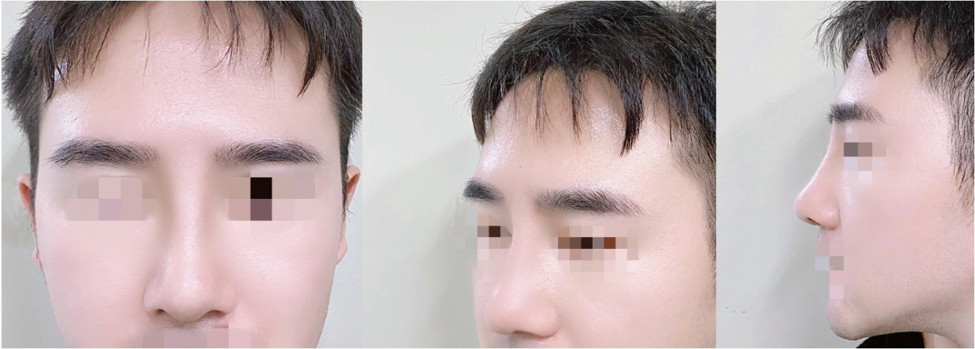 코수술하고 인상이