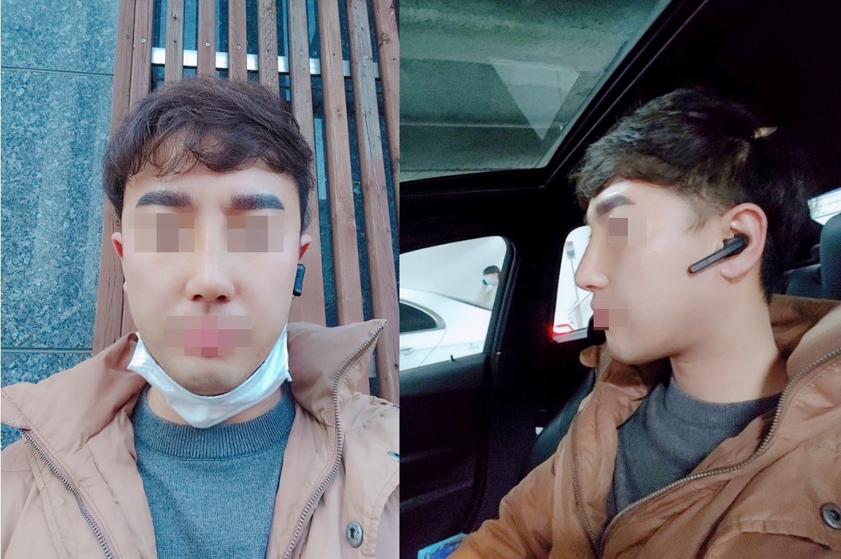남자 코성형 후기입니다