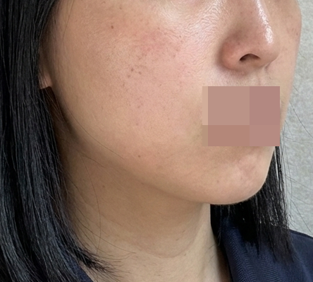 2일 차부터 잔주름 잡힌 게 보여요! 쥬베룩 대만족이에요