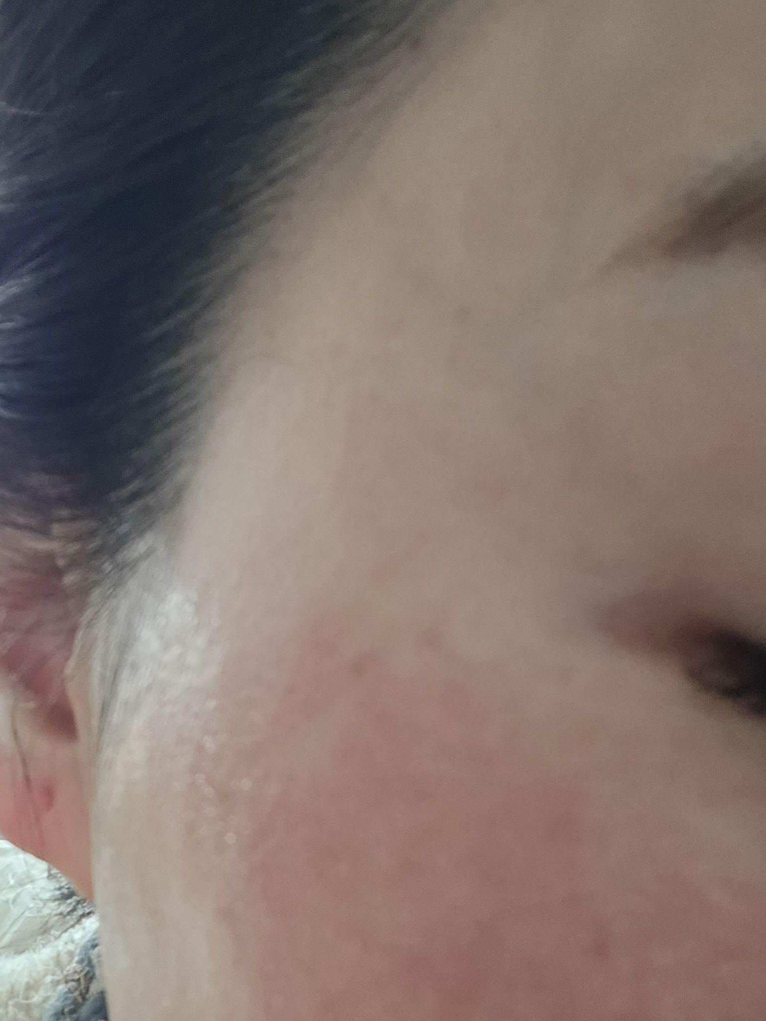 수면으로 통증 없이 받은 포텐자, 일주일 뒤 결과가 기대돼요~!