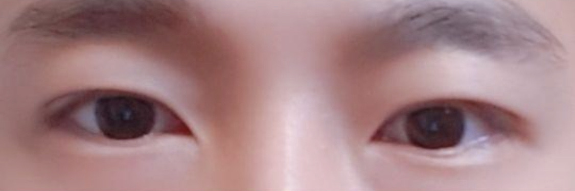 쌍꺼풀 후기입니다