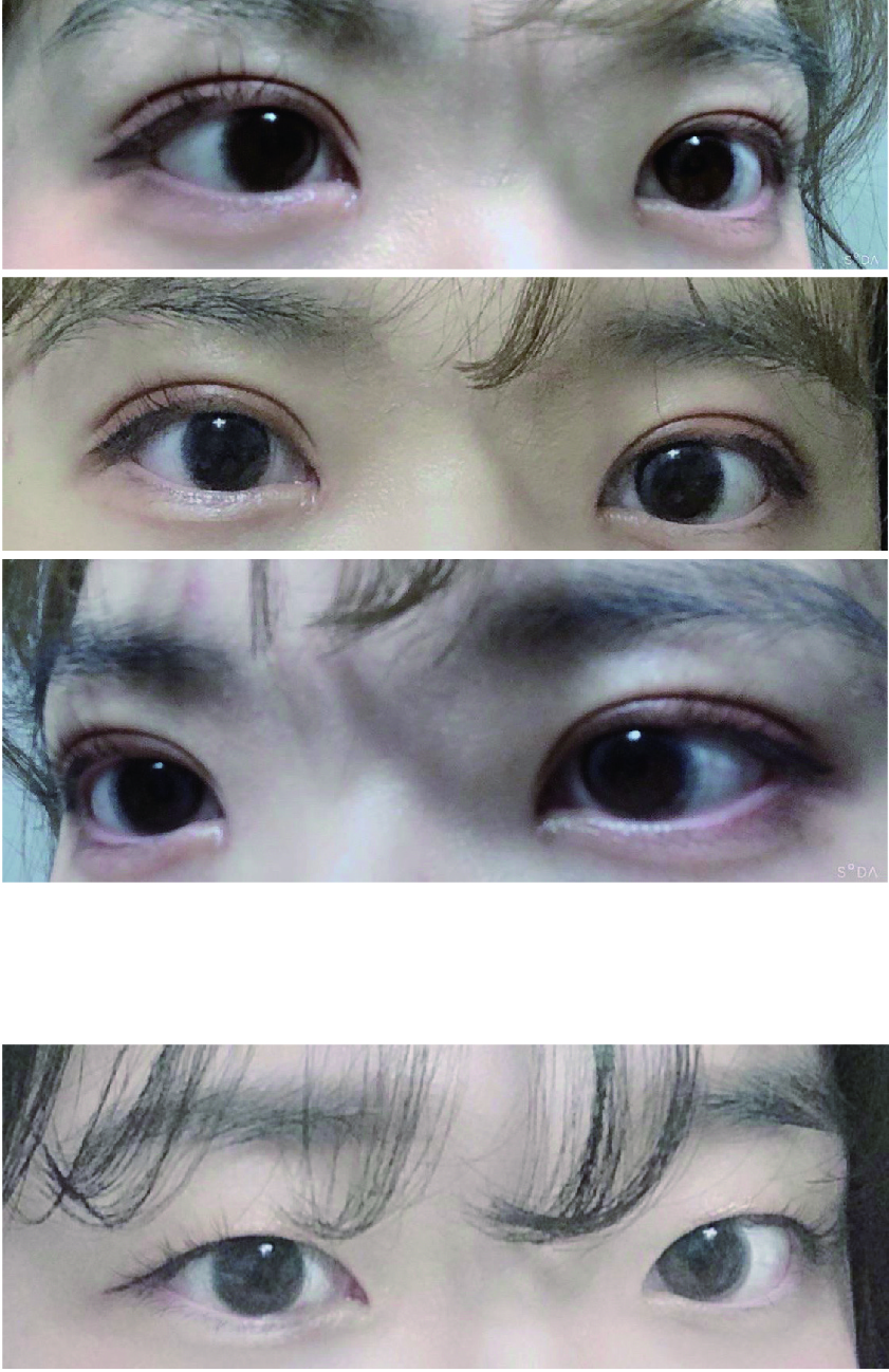 첫 눈수술 대성공아닌가용??