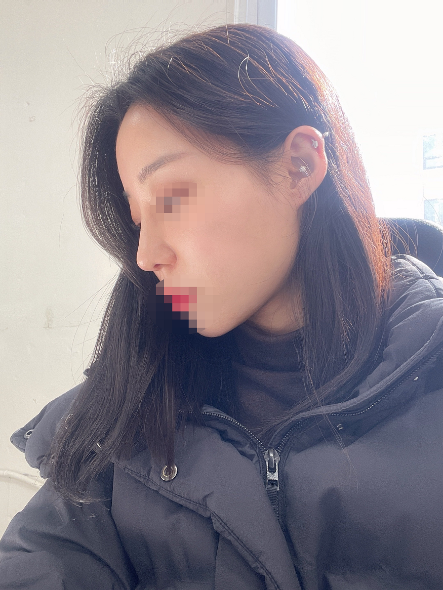 붓기도 많이 없고 만족스러워용