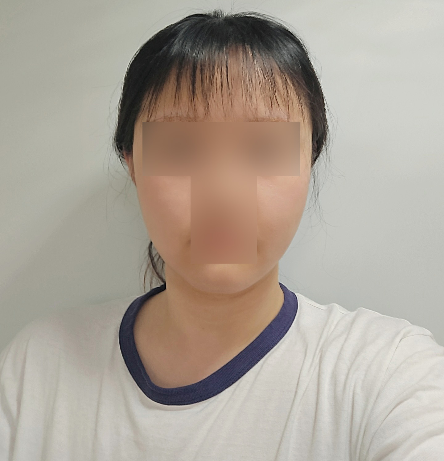 이중턱 + 턱라인 지흡 1달차, 얼굴이 훨씬 작아보여요