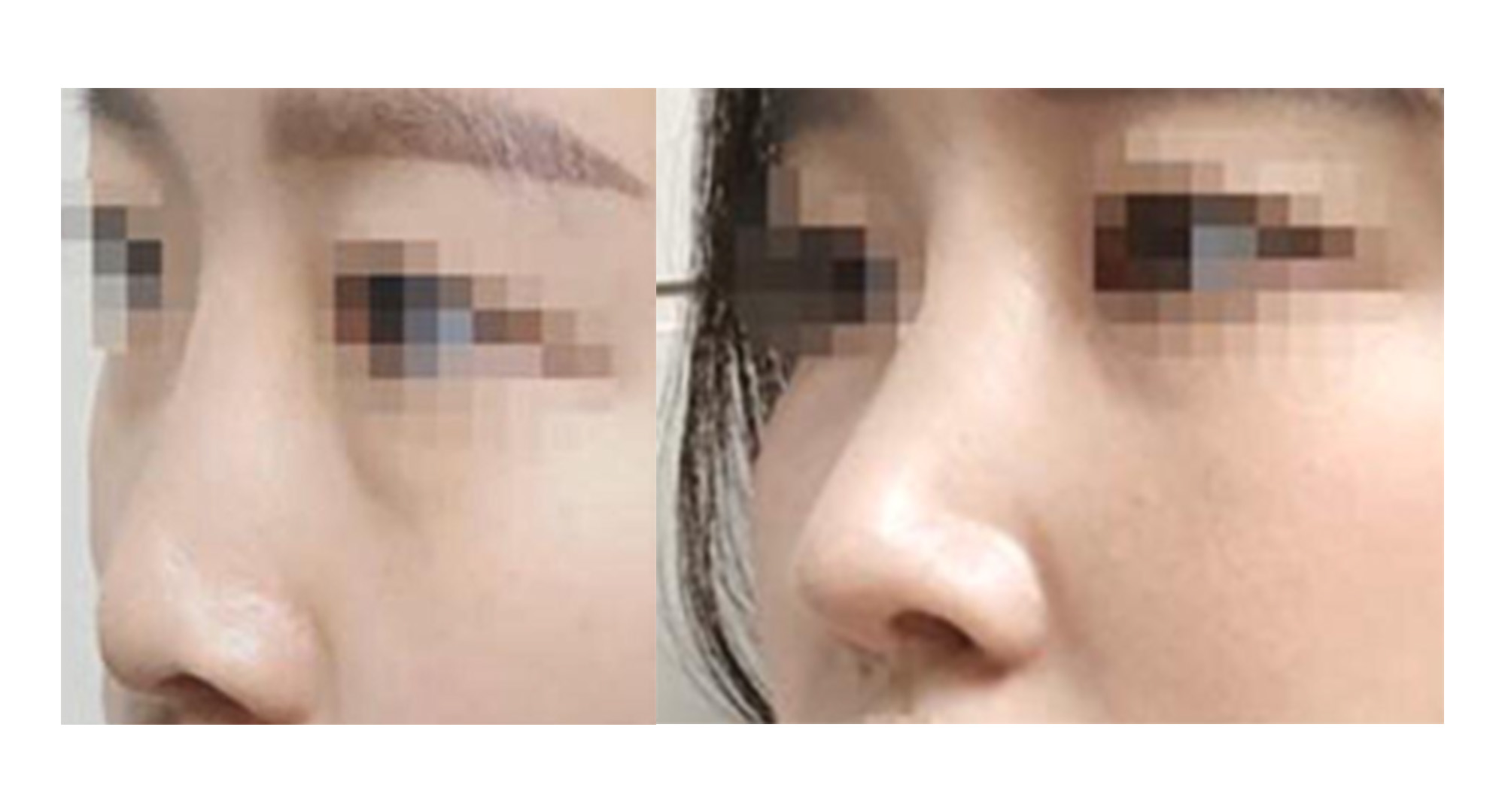 아픈건 잠깐...예쁜건 평생~^^ 코 했어용~~